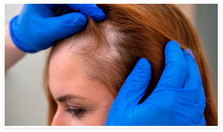 Doctor revisando a una paciente con alopecia