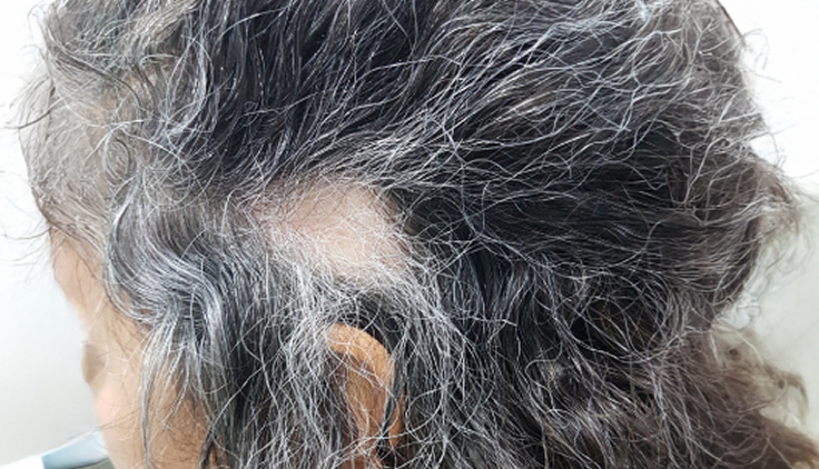 Cabeza de una persona con alopecia areata