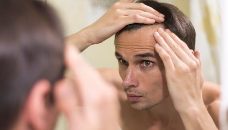 hombre observando que tiene alopecia androgénica