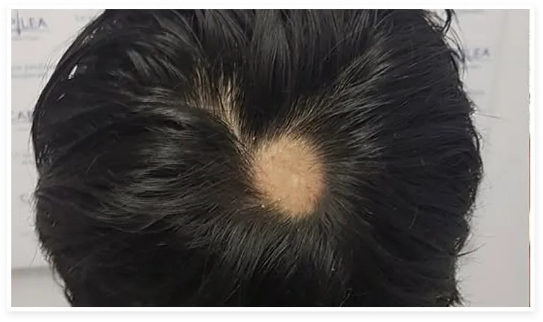 Cabeza de una persona con alopecia areata